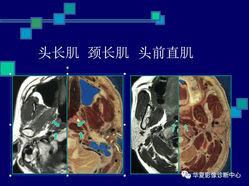 鼻咽與咽旁間隙的影像解剖