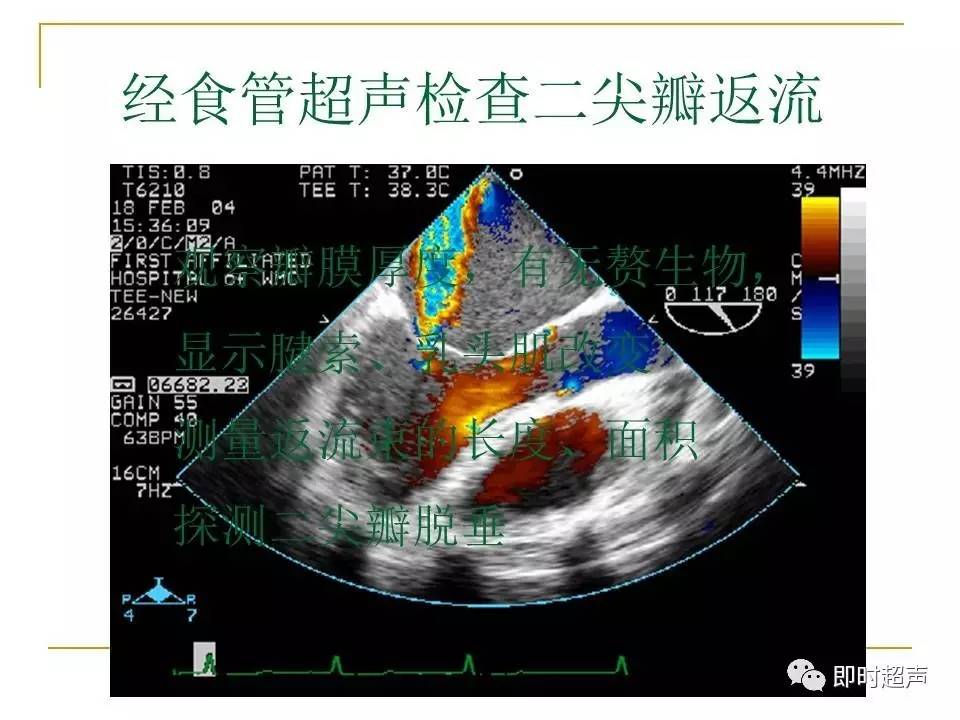 心臟瓣膜病超聲診斷