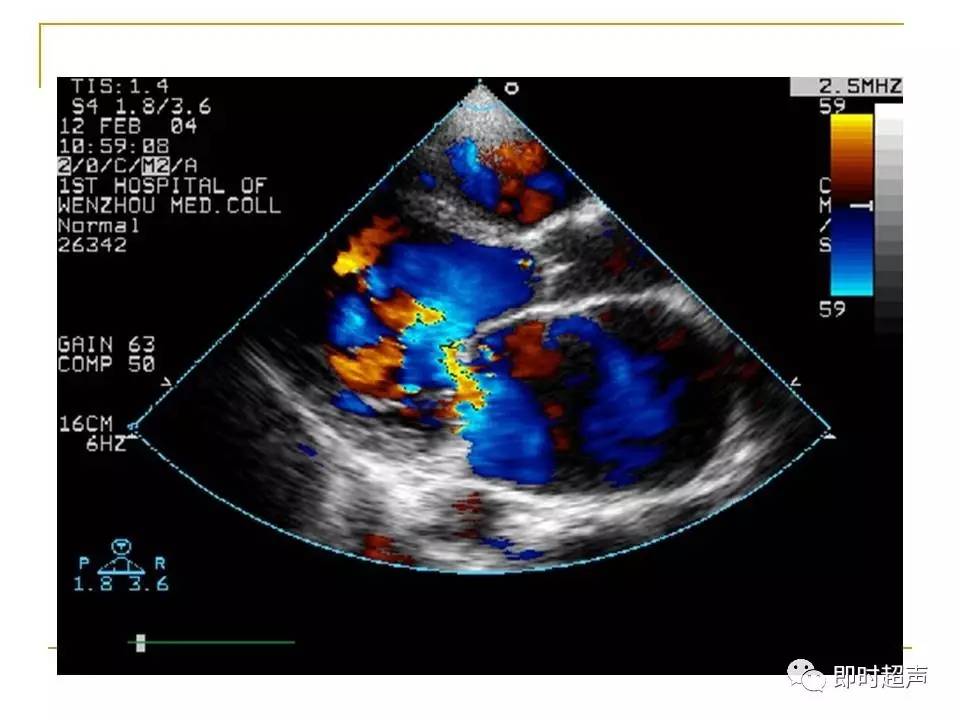 心脏瓣膜病超声诊断