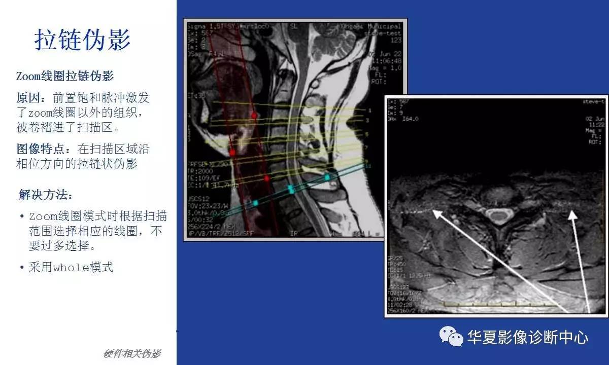 关于磁共振伪影