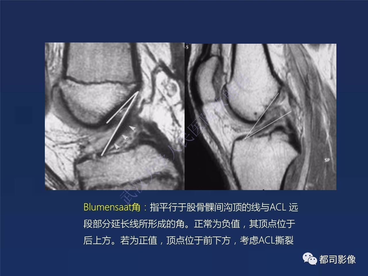 前交叉韧带损伤及重建术后mr评价