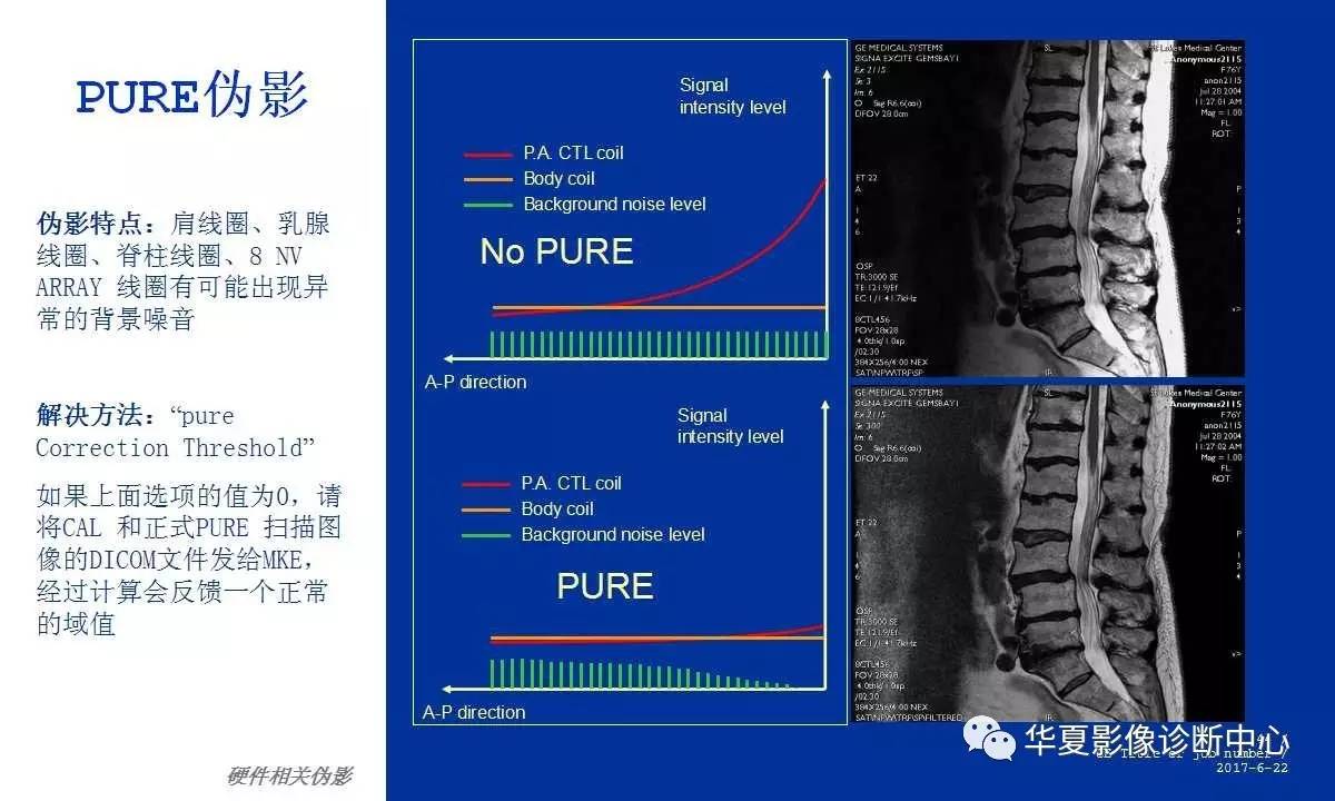 关于磁共振伪影