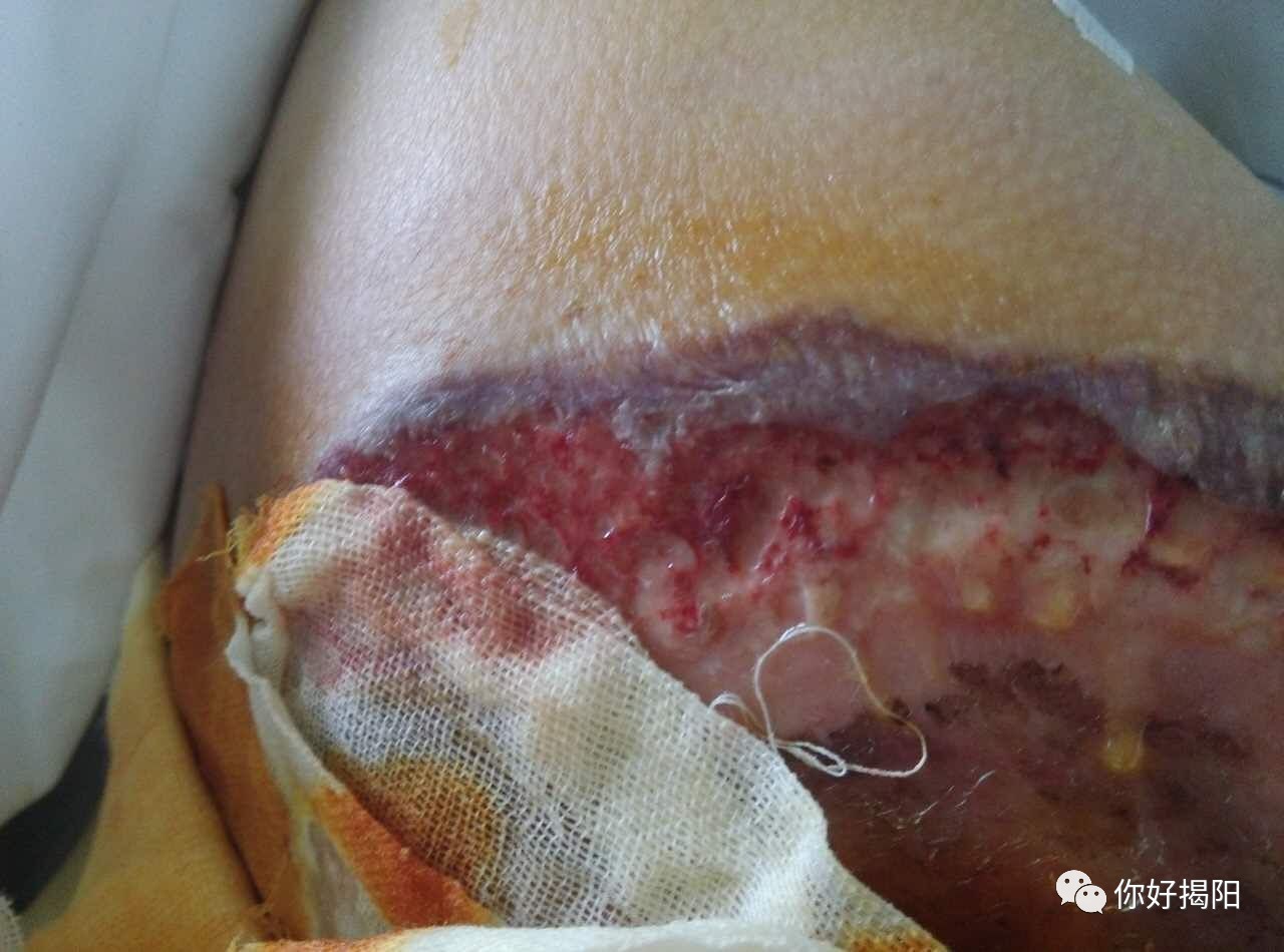 肛周脓肿术后刀口图片图片