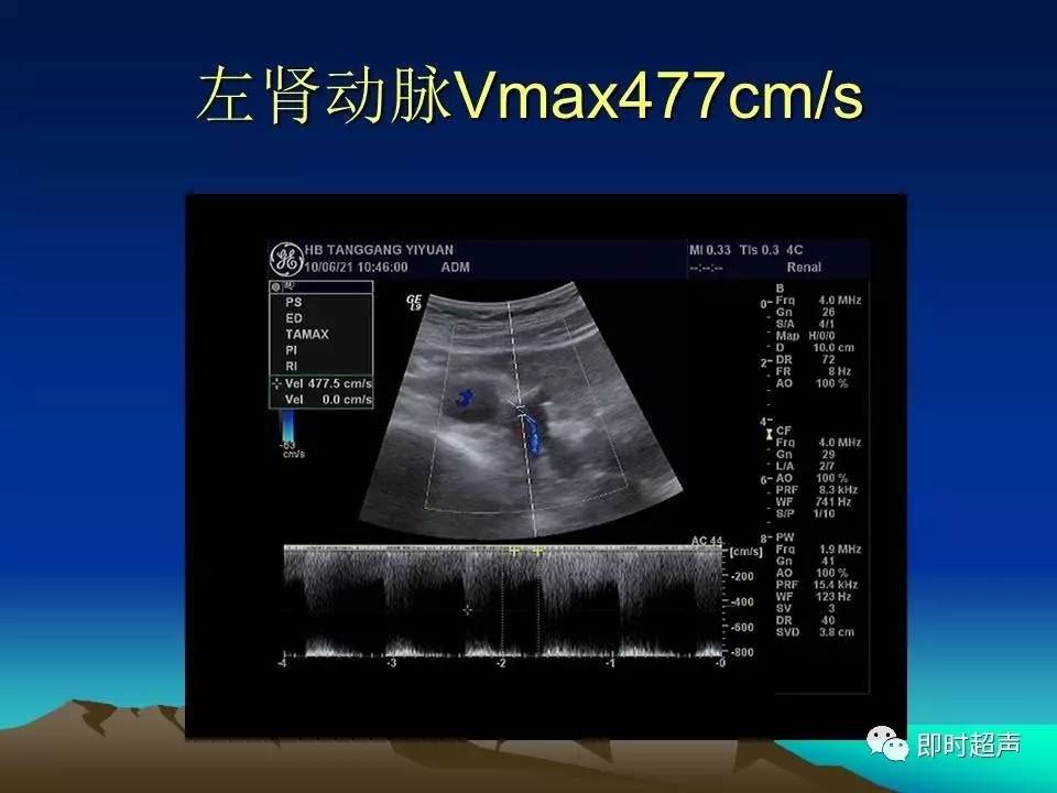 肾动脉解剖位置超声图图片