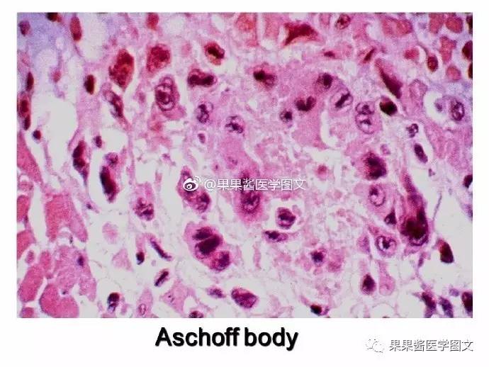 aschoff 小体:在风湿病中,由成群的aschoff细胞聚集于纤维素样坏死灶
