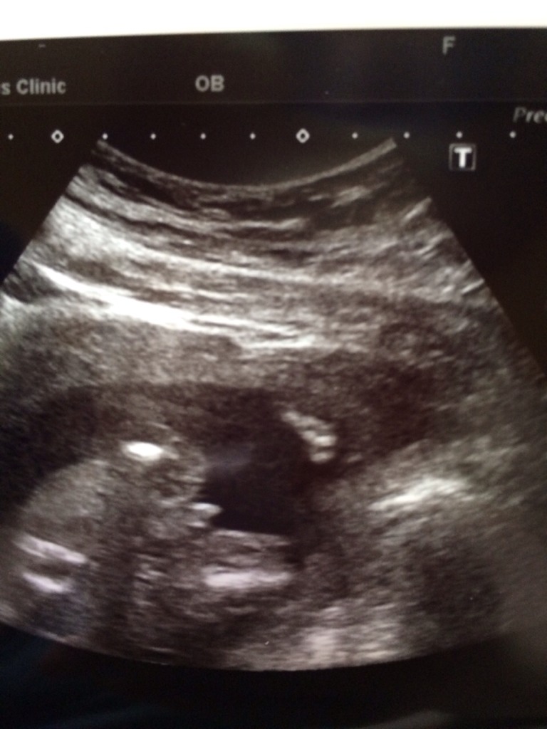 八个月男宝睾丸彩超图图片