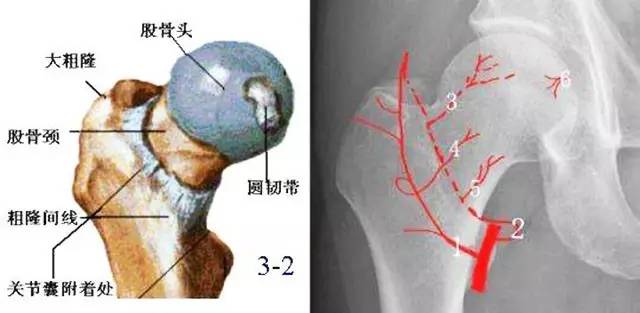從而導致的股骨頭處的細胞缺血性壞死,骨小梁斷裂,股骨頭塌陷的一種