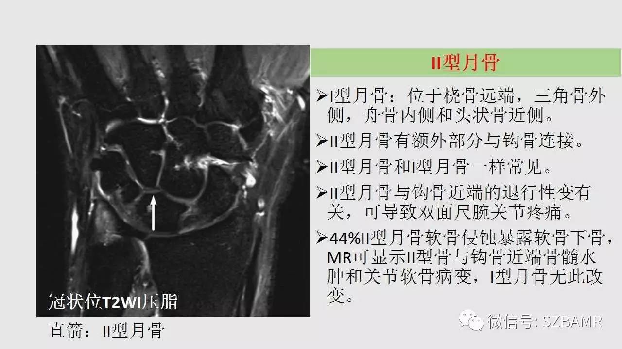 腕手磁共振成像正常解剖与变异