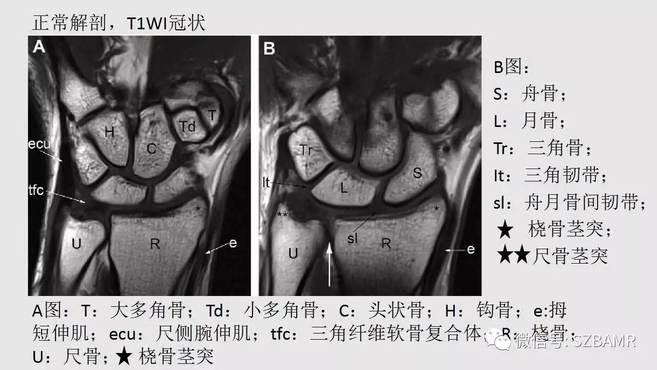 腕手磁共振成像正常解剖与变异