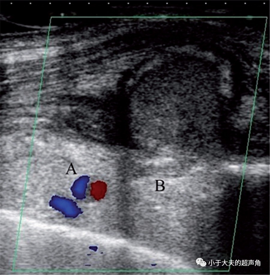 假性动脉瘤超声图片