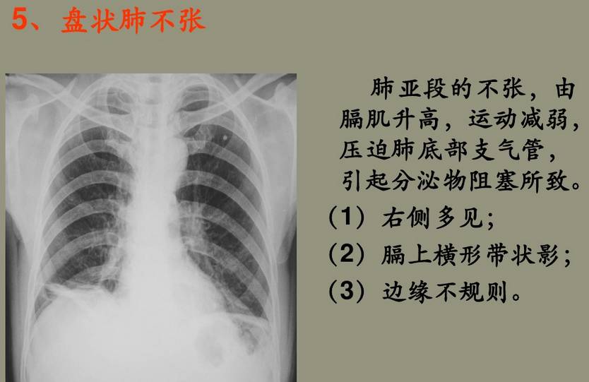 肺不张x线影像学表现图片