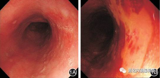 图1早期食管癌典型病例1a:白光内镜下距门齿29～34 cm食管后壁见一