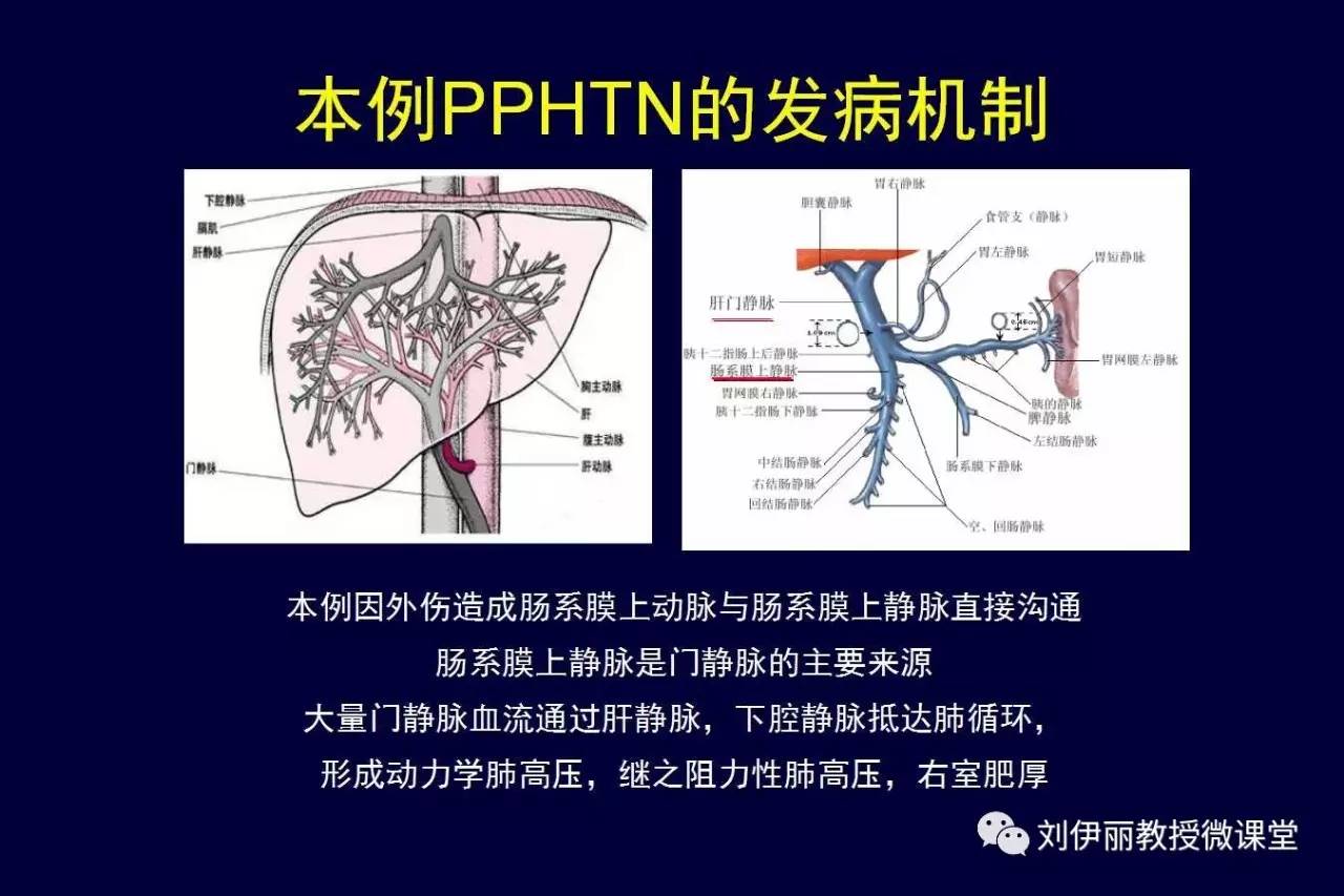 外傷性門靜脈肺動脈高壓症