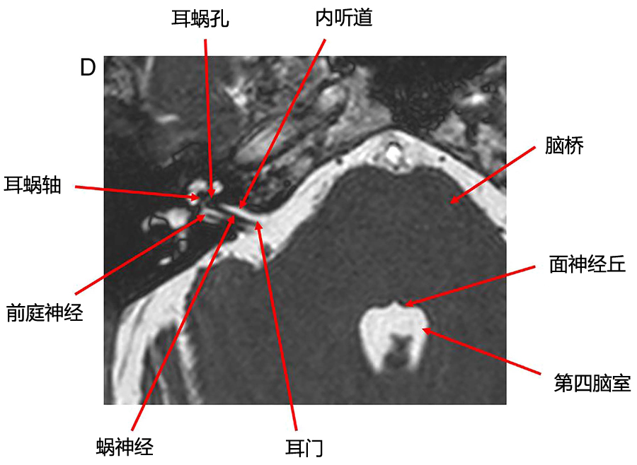 桥小脑角区解剖彩图图片