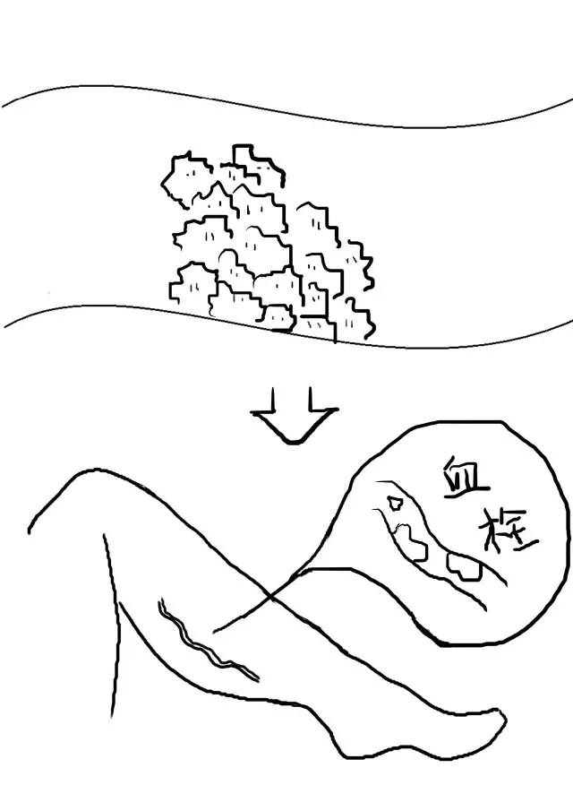 血栓图手绘图图片