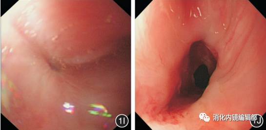 201703病例食管胃底靜脈曲張出血合併早期食管癌內鏡診治一例