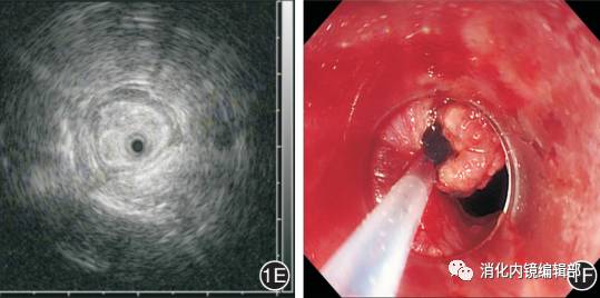 201703病例食管胃底靜脈曲張出血合併早期食管癌內鏡診治一例