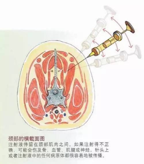 豬隻運用標準工作法——肌內注射(二)