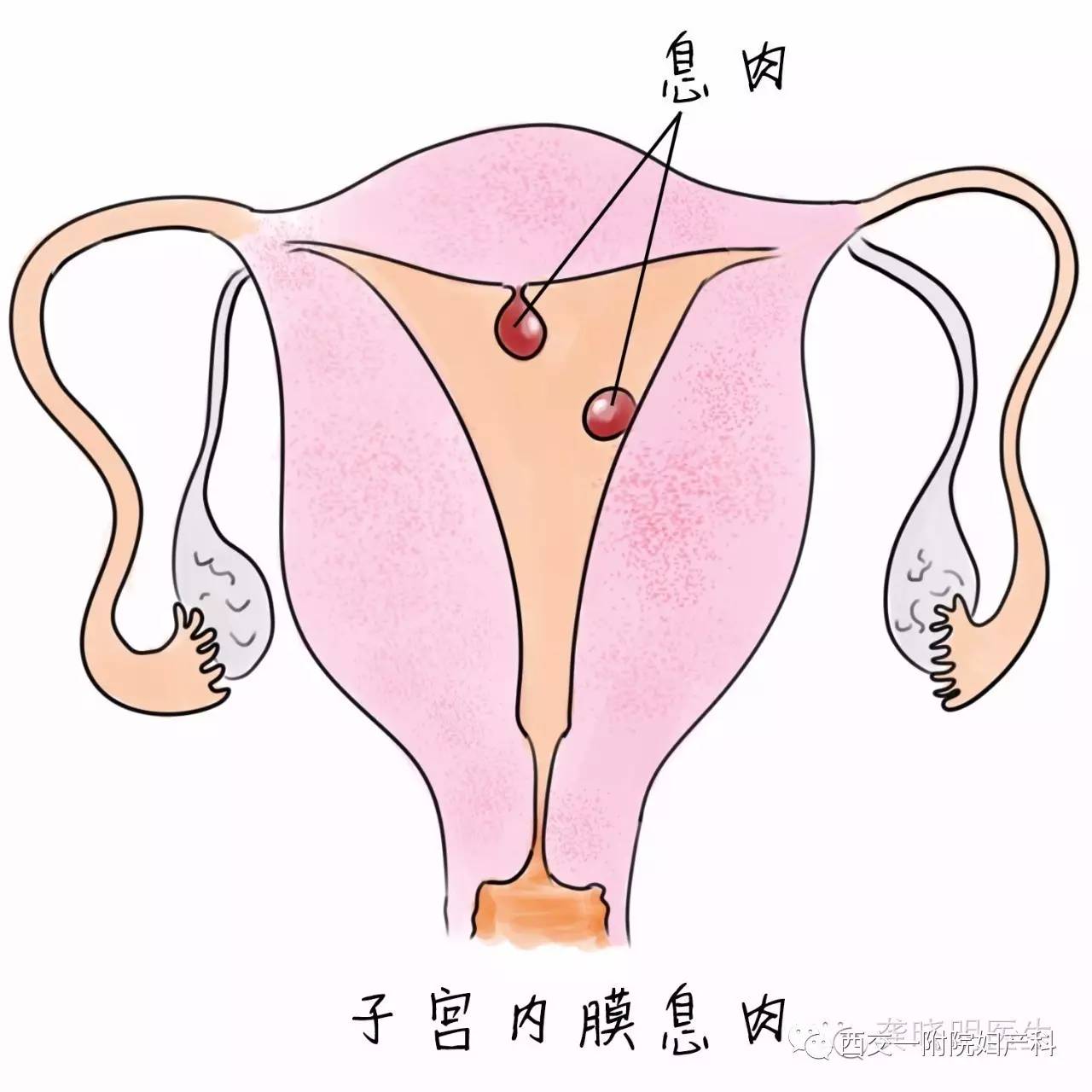 其影像學特點為月經乾淨3-7天行b超檢查提示子宮內膜回聲不均勻,宮腔