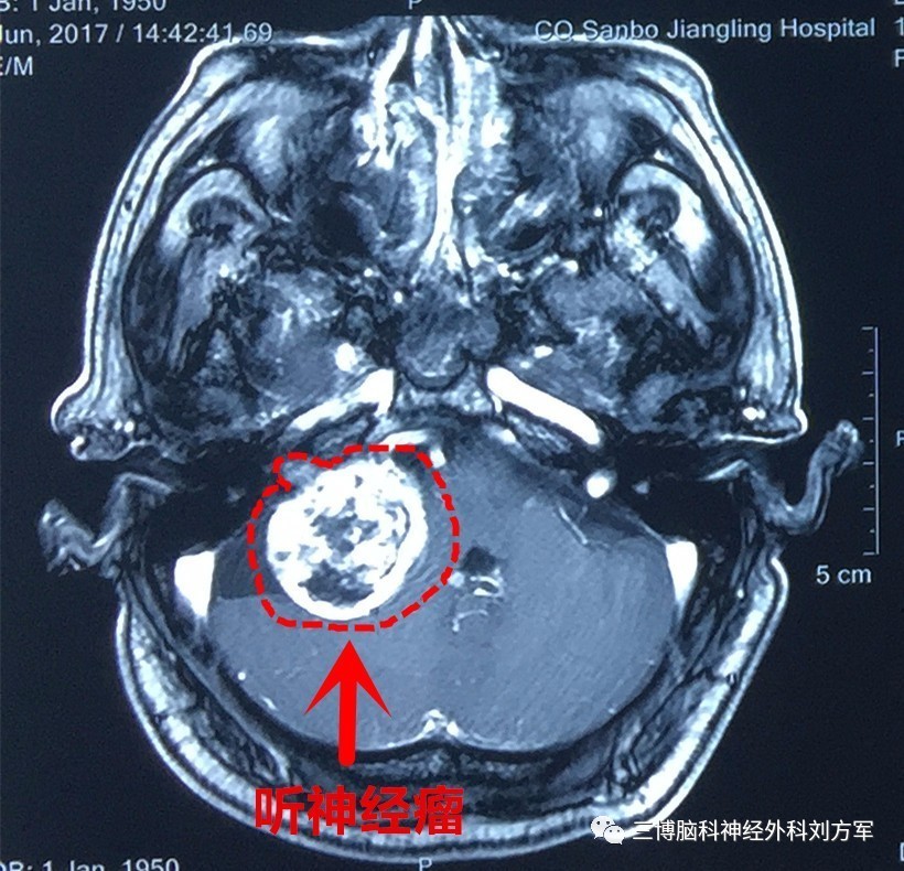 右侧cpa开颅听神经鞘瘤切除术