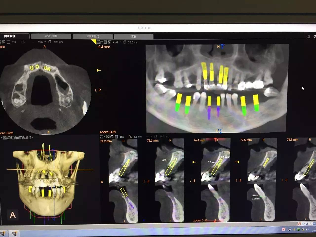 7月4日庆云口腔医院一例10颗种植病例