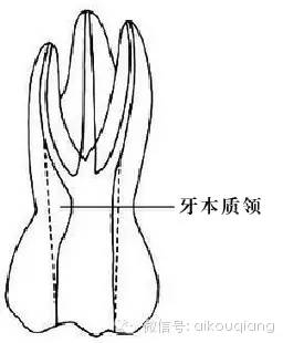 4,有时可以去除部分牙本质领(见下图,但我认为这个地方还是用金刚砂