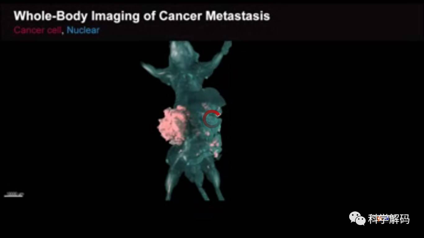 癌细胞扩散后解剖图片图片