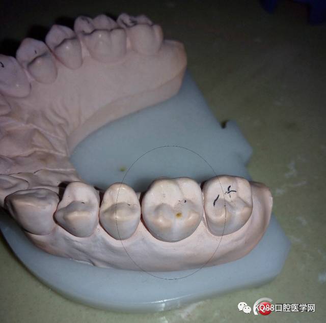 下颌第一磨牙雕刻图图片