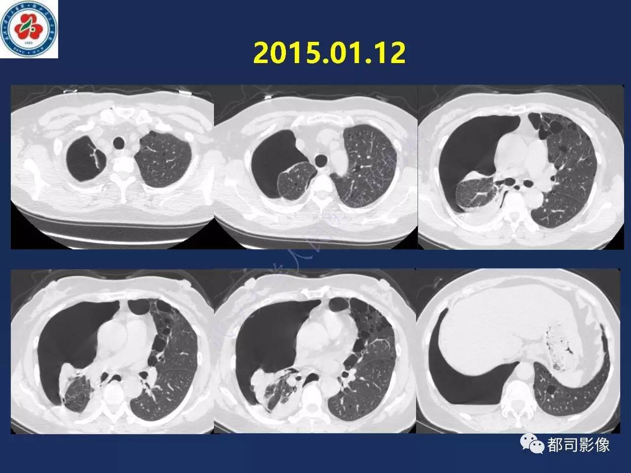 肺淋巴管肌瘤病影像诊断