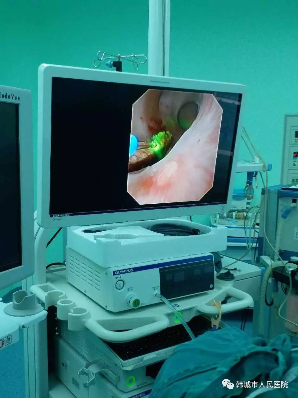 医疗动态泌尿外科成功进行输尿管软镜右肾结石钬激光碎石取石术