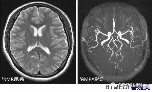 头颅血管成像图解图片