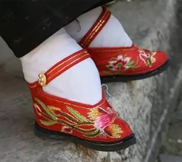 这是在x光下,中国缠足女性的脚,也是中国古代以之为美的三寸金莲