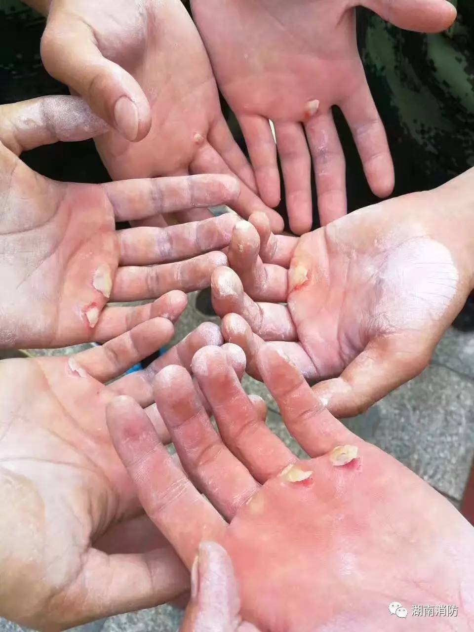 消防兵受伤的手图片
