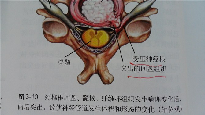 腰間盤突出ldp三刀法:骶髂肌群鬆解的肌肉能量技術met:髂腰肌的治療