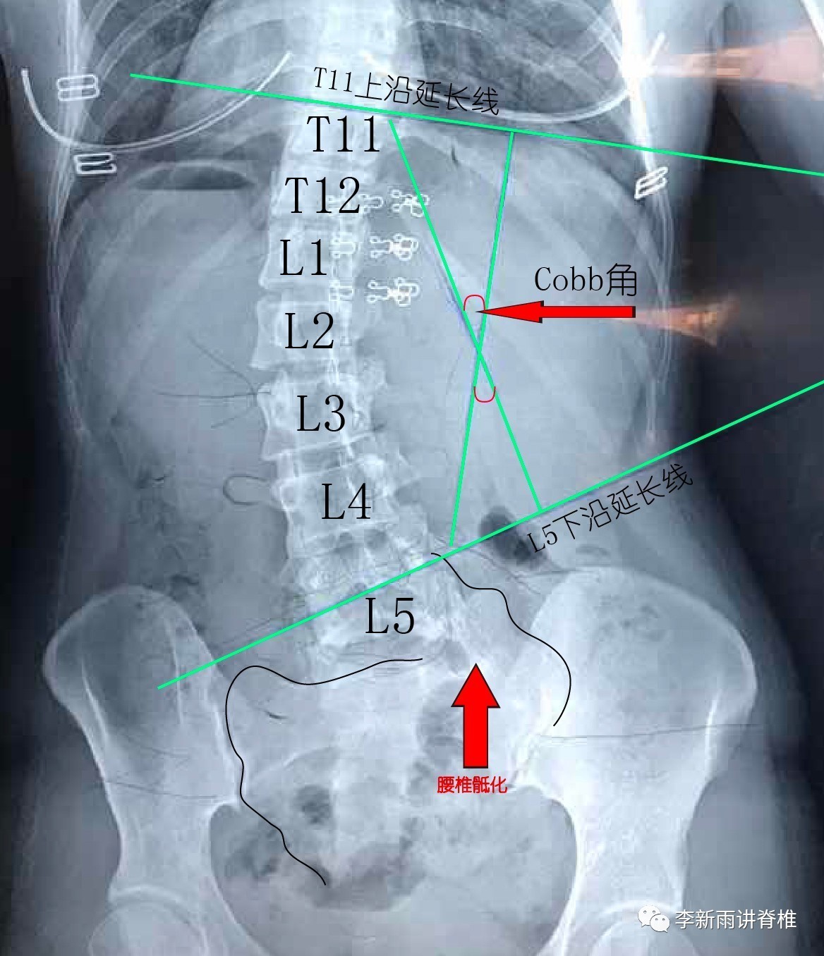 t12椎体在什么位置图片