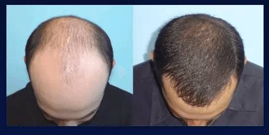 惊呆秃顶也能长出新头发日本基因生发黑科技让脱掉的头发长回来不看亏