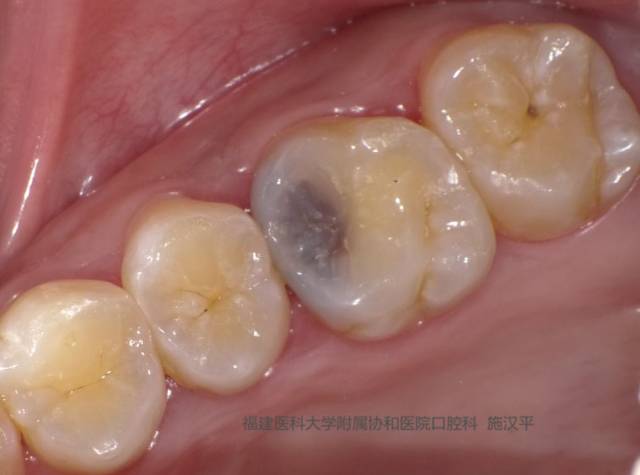 临床诊断:深龋26见合面靠近近中边缘嵴牙体发黑,表面釉质完整,叩(—)