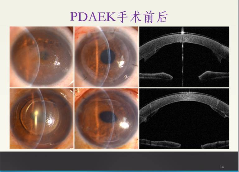 角膜内皮失代偿图片