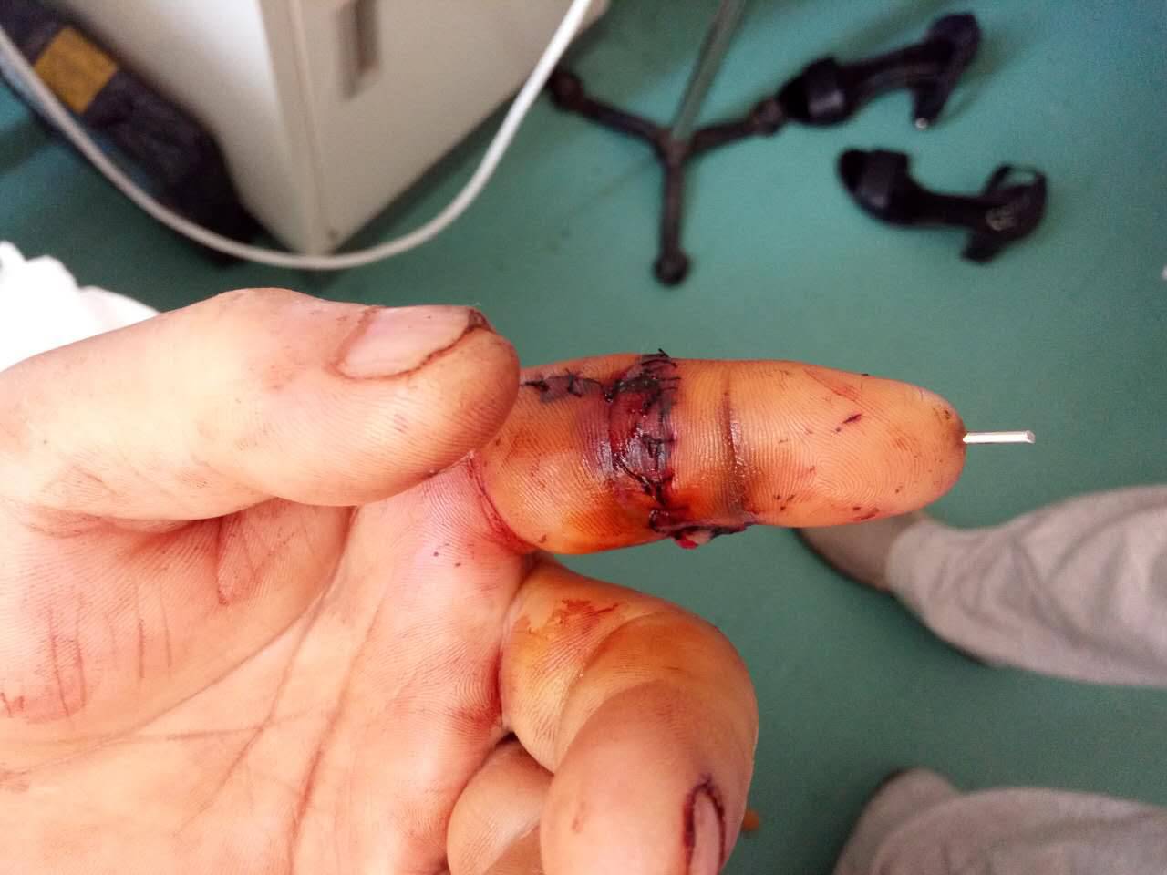 科是以骨科为基础,显微外科为特色的科室,近年来完成多例手指离断再植