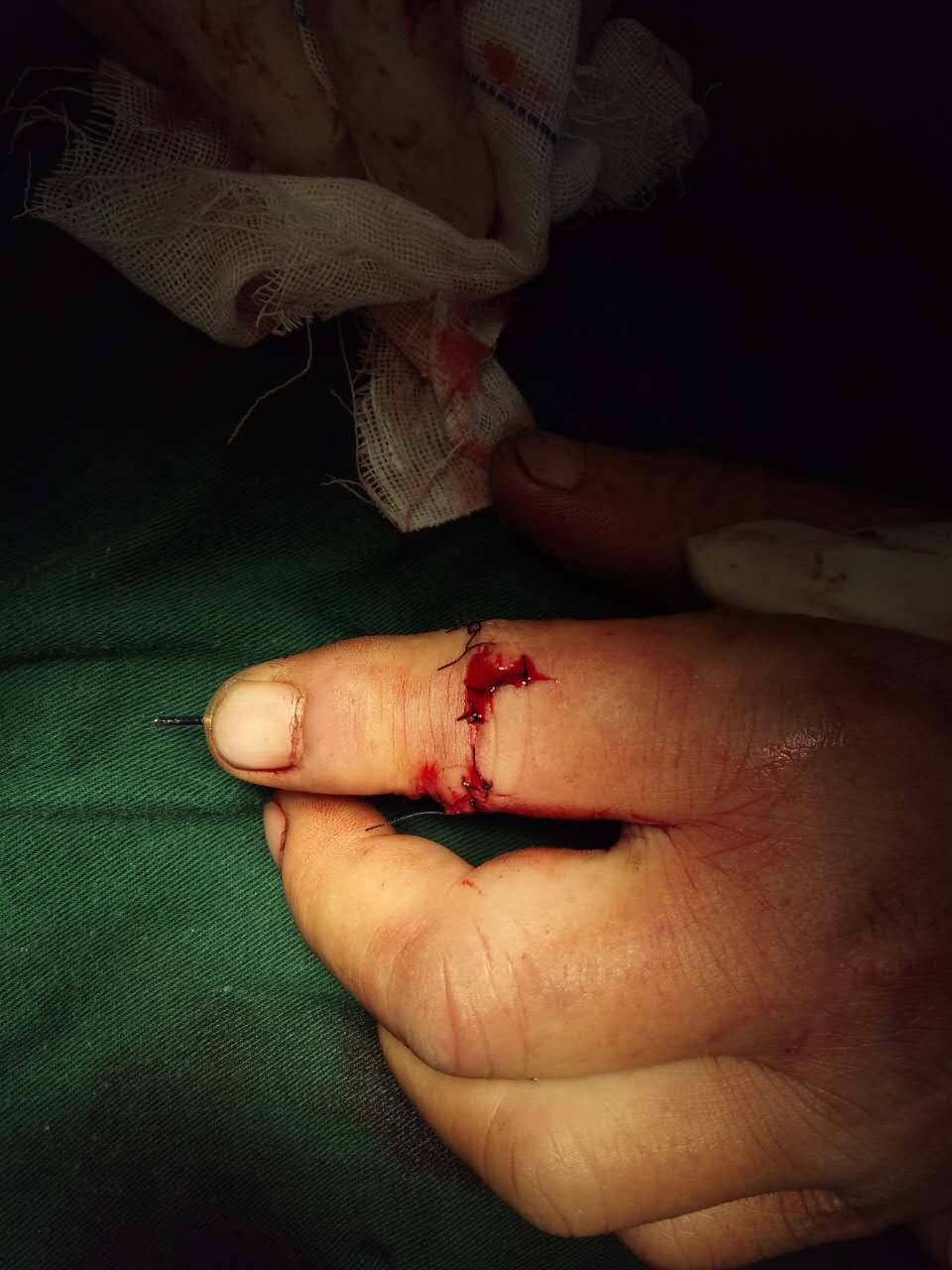 显微外科为特色的科室,近年来完成多例手指离断再植,高难度指尖离断