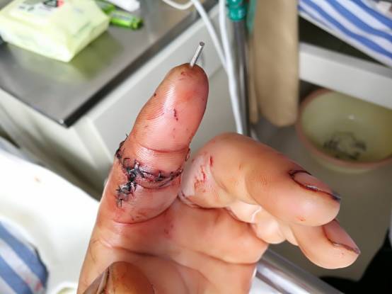 科是以骨科为基础,显微外科为特色的科室,近年来完成多例手指离断再植