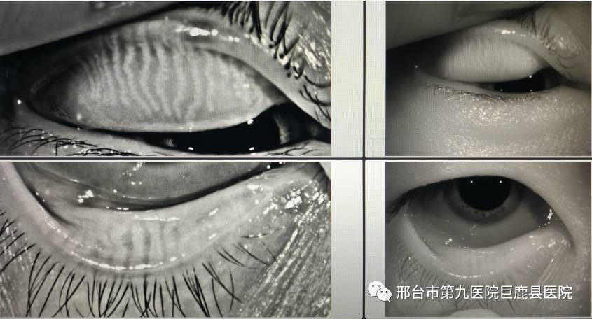 乾眼症患者福音德國oculus眼表綜合分析儀落戶邢臺市第九醫院