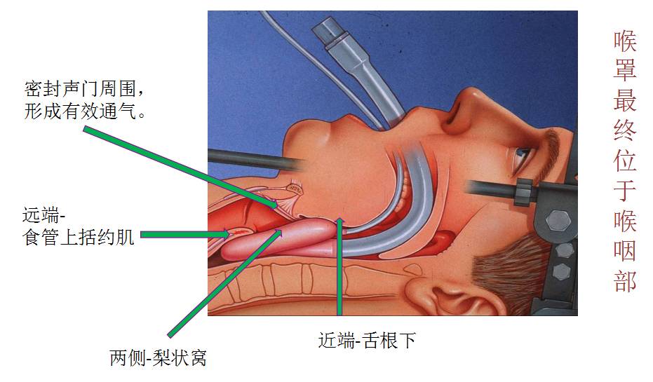 困难气道的识别与抢救配合