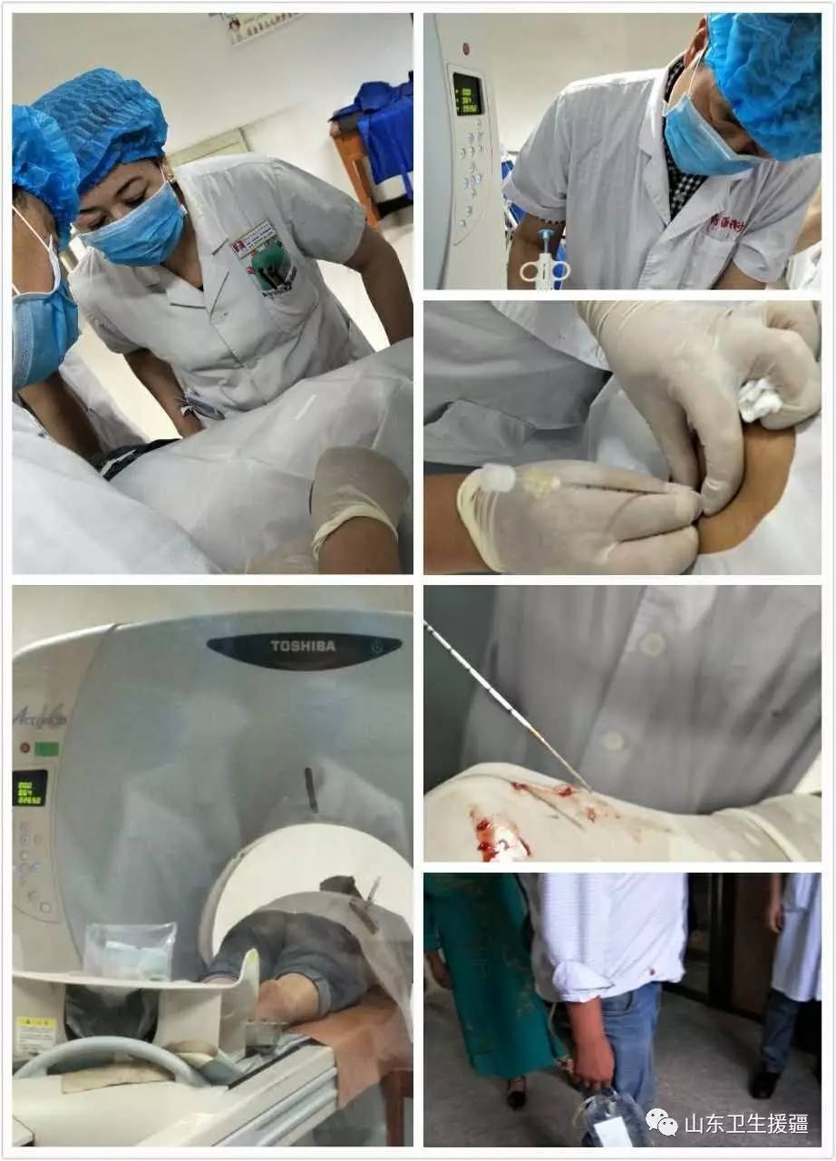 卫生援疆喀什地区肺科医院完成首例ct引导下胸膜活检及置管引流术