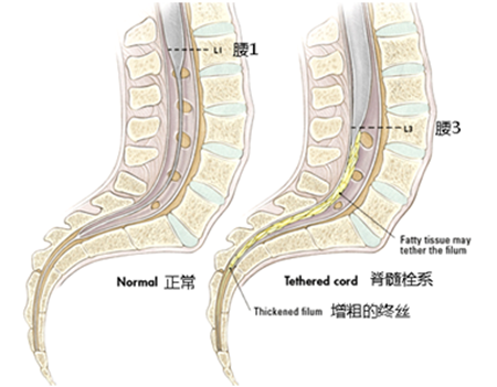 脊髓栓系症状图片