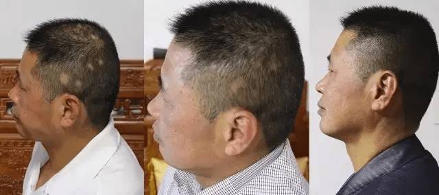 惊呆秃顶也能长出新头发日本基因生发黑科技让脱掉的头发长回来不看亏