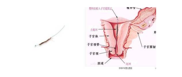 含銅無支架iud 吉妮環↓可放置20年宮銅iud↓放置年限5-8年母體樂