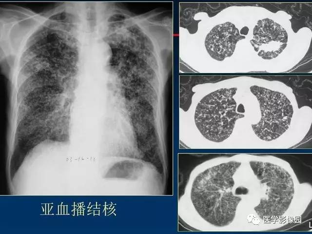 慢性血行播散型肺结核图片