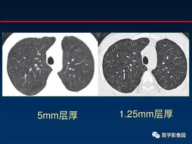 慢性血行播散型肺结核图片