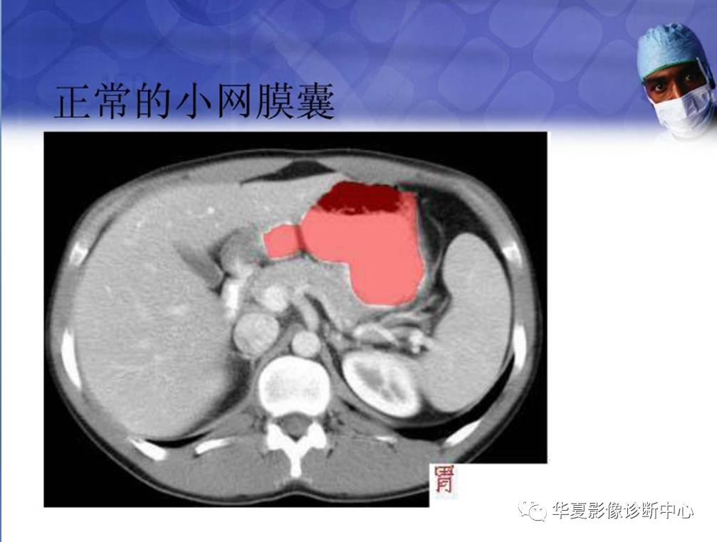 ct在上消化道穿孔中的应用